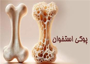 30 درصد افراد بالای 50 سال خراسان شمالی به پوکی استخوان مبتلا هستند